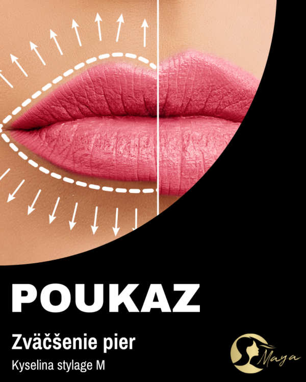 Zväčšenie pier (Kyselina stylage M) (HYALURON PEN)