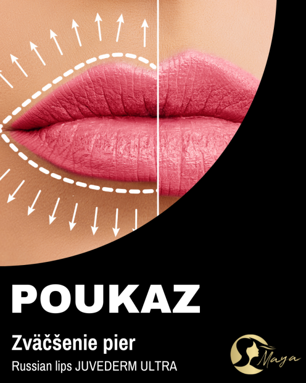 Zväčšenie pier Russian lips JUVEDERM ULTRA (HYALURON PEN)